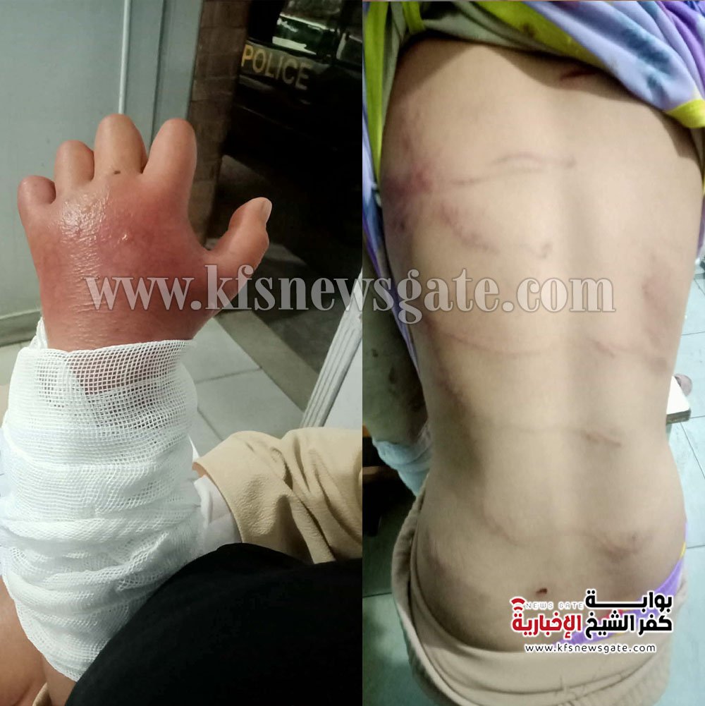 طفلة كفر الشيخ.."نورهان" ضحية قسوة أب وغياب الرحمة - صور