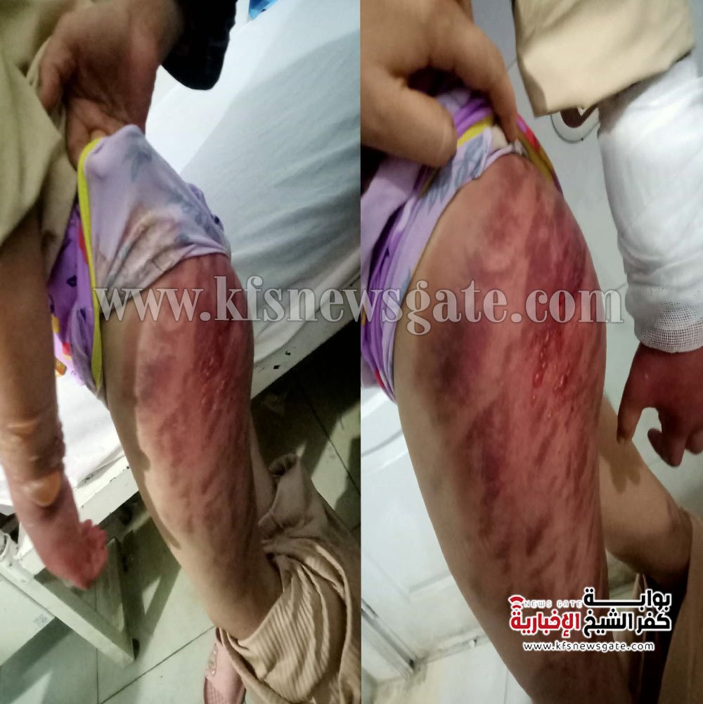 طفلة كفر الشيخ.."نورهان" ضحية قسوة أب وغياب الرحمة - صور